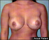 Breast Lift and Augmentation Patient