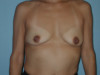 Breast Augmentation Patient