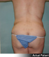 Liposuction Patient