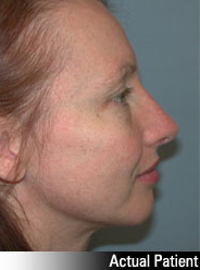 Patient # 21025 After Photo # 4