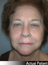 Facelift Patient