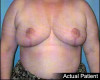 Breast Reduction Patient