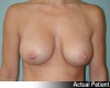 Breast Augmentation Patient