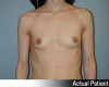 Breast Augmentation Patient