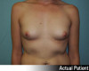 Breast Augmentation - Gummy Bear Implants Patient