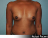 Breast Augmentation - Gummy Bear Implants Patient