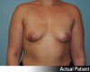 Breast Augmentation Patient