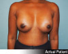 Breast Augmentation Patient