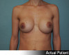 Breast Augmentation Patient