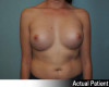 Breast Augmentation - Gummy Bear Implants Patient