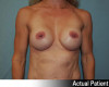 Breast Augmentation Patient