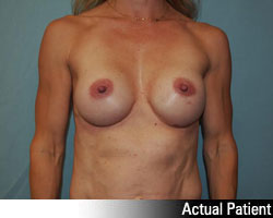 Patient # 32872 After Photo # 2