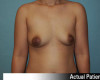 Breast Augmentation - Gummy Bear Implants Patient