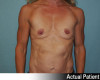 Breast Augmentation Patient