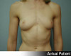 Breast Augmentation Patient