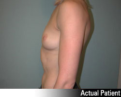 Patient # 17393 Before Photo # 5