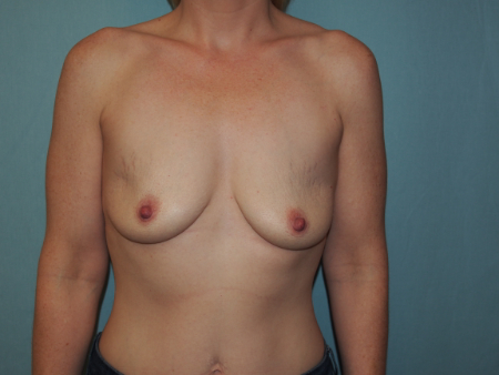 Breast Augmentation Patient