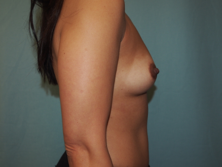 Patient # 18817 Before Photo # 3