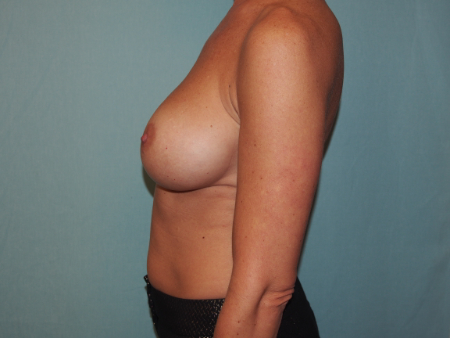 Patient # 56986 After Photo # 4