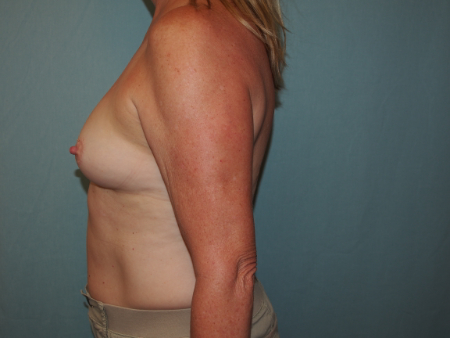 Patient # 84632 Before Photo # 3