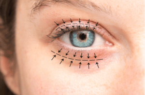 Arrows show the planned blepharoplasty surgery to lift and correct the skin and swelling.