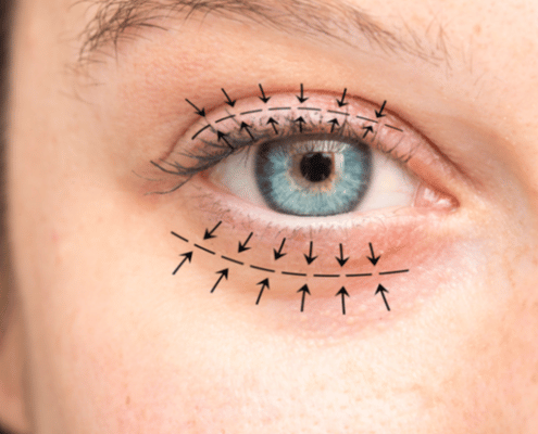 Arrows show the planned blepharoplasty surgery to lift and correct the skin and swelling.