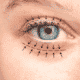 Arrows show the planned blepharoplasty surgery to lift and correct the skin and swelling.