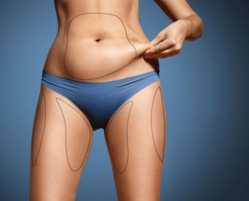 Body with marked zones for liposuction