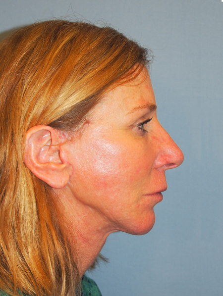 Patient # 15603 After Photo # 6