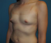 Breast Augmentation Patient