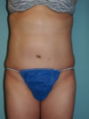 Tummy Tuck Patient