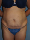 Tummy Tuck Patient