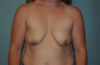 Breast Augmentation Patient