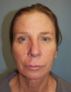Face Lift and Neck Lift Patient