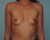 Breast Augmentation Patient