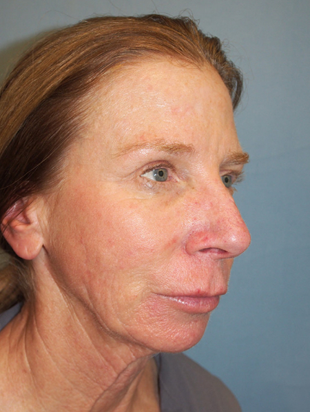 Patient # 15603 Before Photo # 3