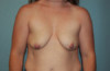 Breast Augmentation Patient